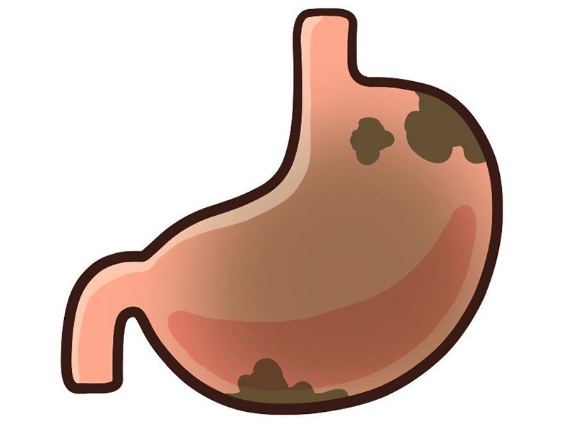 胃がん/大腸がん